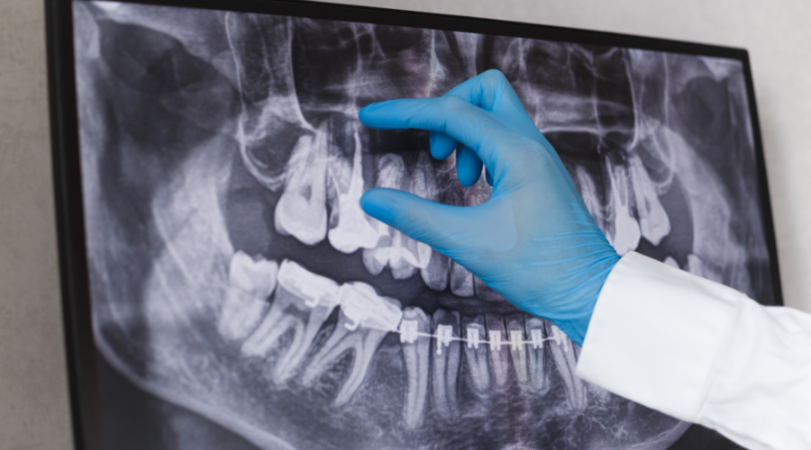 Why you should get your root canal/s removed ASAP